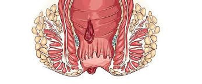 ما هي البواسير
